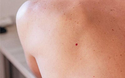 ஆயுள் காக்கும் ஆயுர்வேதம்: முகம், கன்னங்களில் சிவப்பு மச்சங்கள் குணமாக?