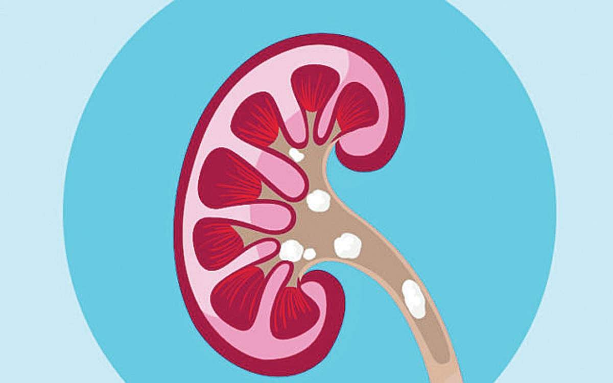 ஆயுள் காக்கும் ஆயுர்வேதம்: சிறுநீரகக் கற்கள் வராமலிருக்க..!