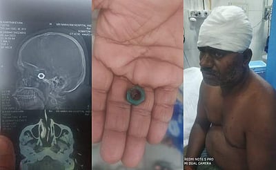 தலைக்குள் போல்ட்டை அகற்றாமல் தையல்: வேலூர் அரசு மருத்துவமனையில் அதிர்ச்சி!