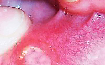 ஆயுள் காக்கும் ஆயுர்வேதம்: நாக்கு புண் ஆற வழி என்ன?