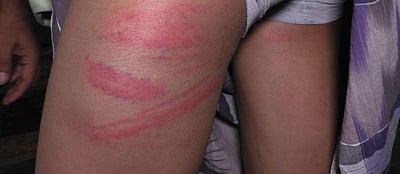 தேர்வில் மதிப்பெண் குறைவு... மாணவ-மாணவியர்களை பிரம்பால் அடித்ததால் ரத்த காயம்