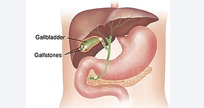 பெண்ணின் பித்தப்பையிலிருந்து 1000 கற்கள் அகற்றி மருத்துவர்கள் சாதனை!