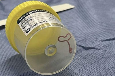 பெண்ணின் மூளையில் உயிருடன் 8 செமீ நீள புழு! மருத்துவர்கள் அதிர்ச்சி!!